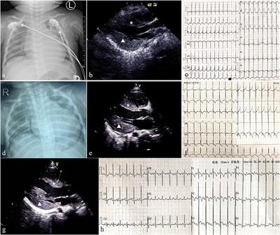 Case Report: Two Chinese Infants of Sengers Syndrome Caused by Mutations in AGK Gene